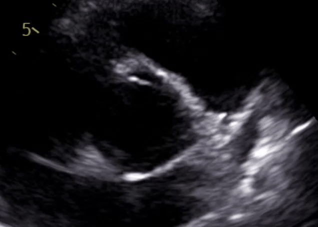 2D echocardiogram aortic valve view